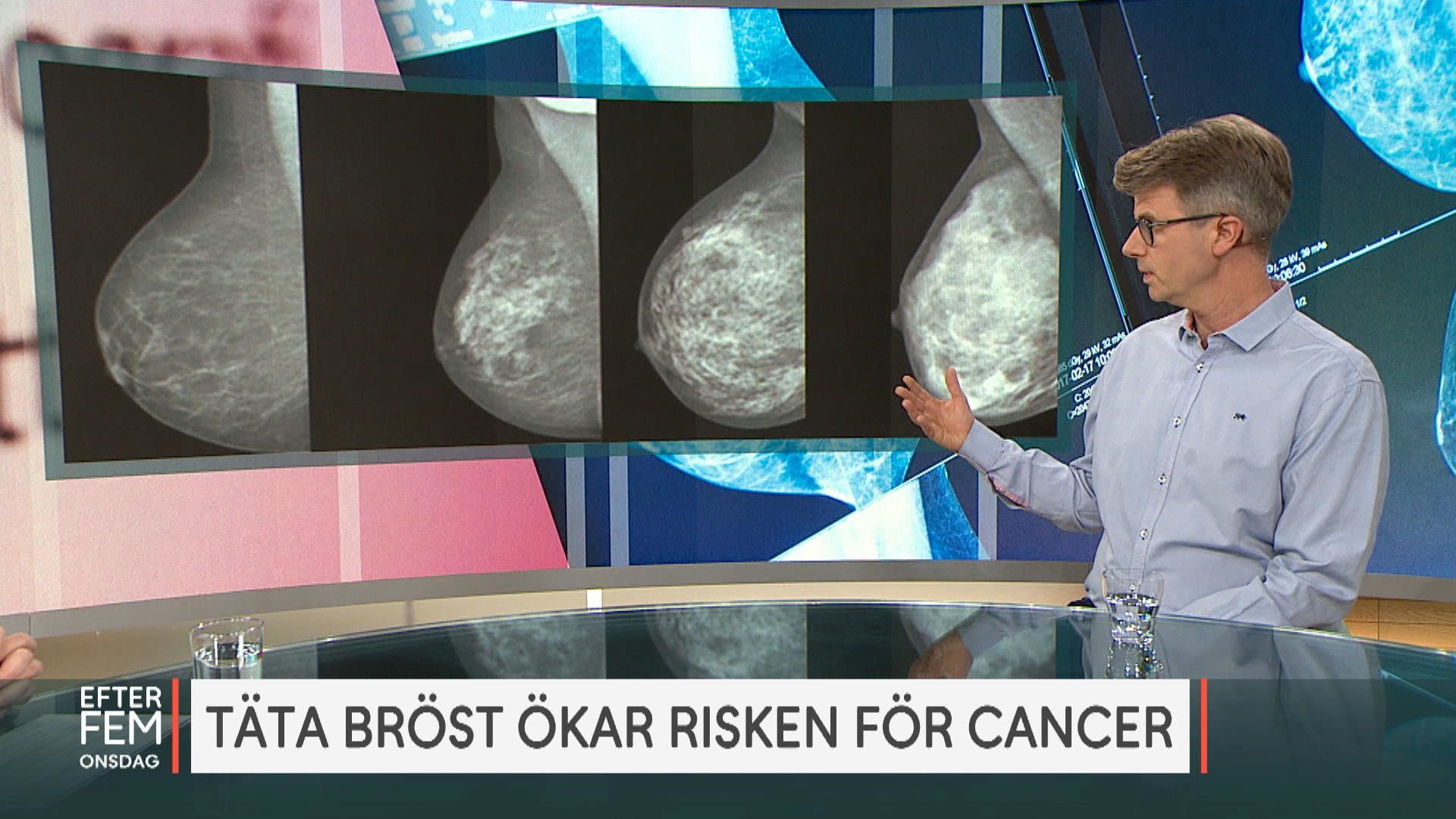 Täta bröst ökar risken för bröstcancer