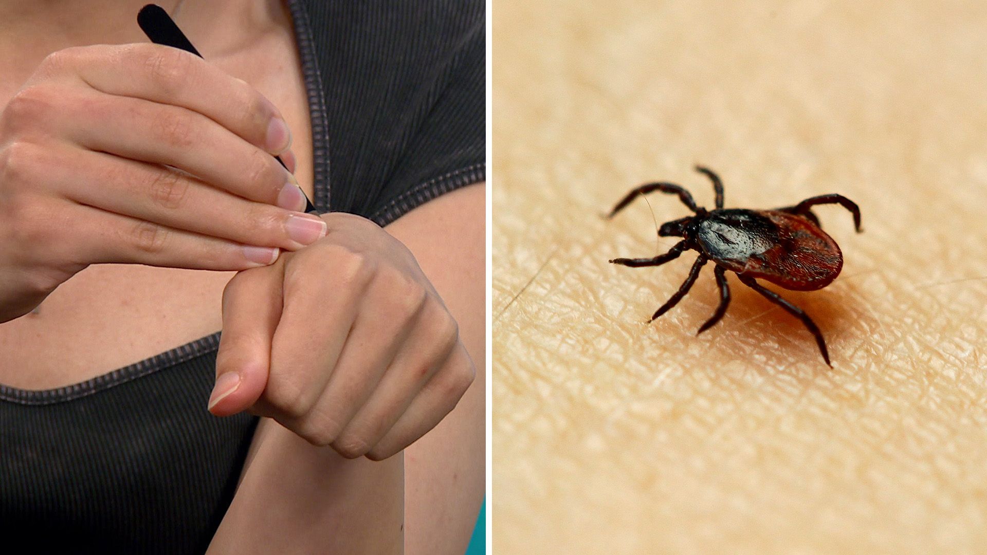 Sommardoktorn – då ska du söka vård för ditt fästingbett